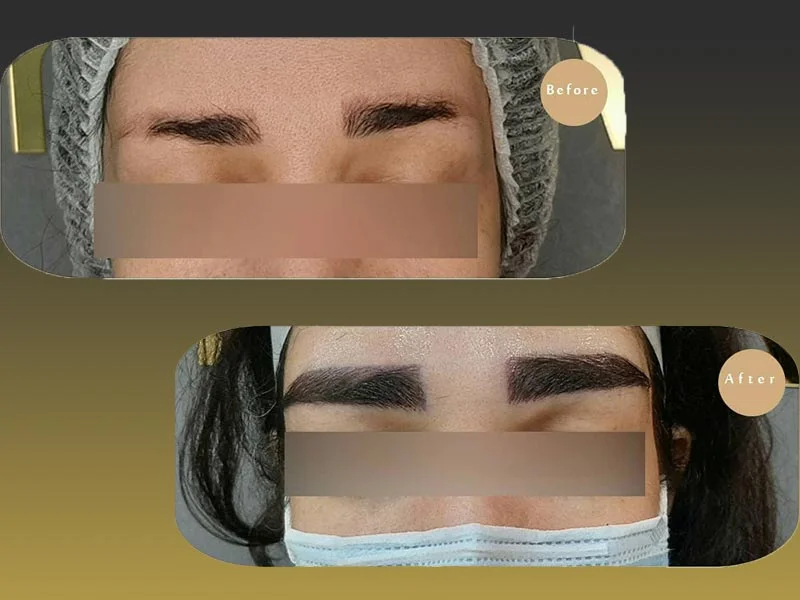 قبل و بعد کاشت طبیعی ابرو