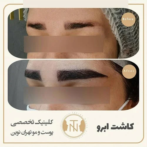 قبل و بعد کاشت ابرو