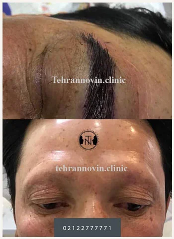 کاشت ابروی مردانه