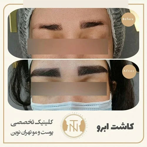 کاشت هر دو ابرو