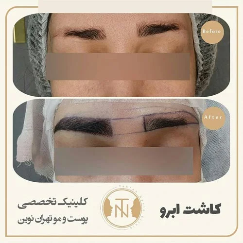 کاشت ابرو