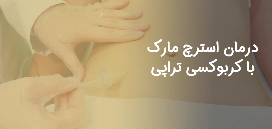 استرچ مارک