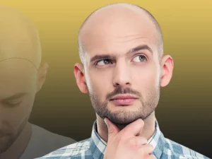 کاشت به روش FUE و FUT