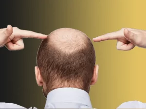 هزینه کاشت مو