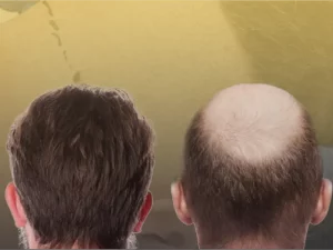 عوارض کاشت مو