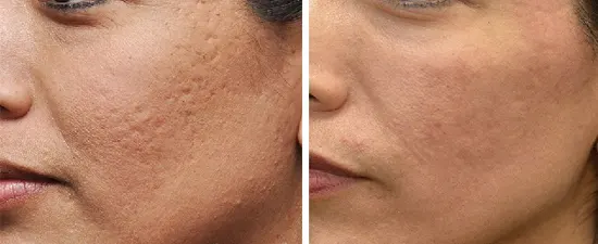 نمونه کار میکرونیدلینگ صورت